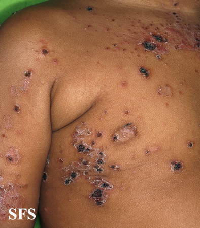 File:Impetigo (Dermatology Atlas 68).jpg
