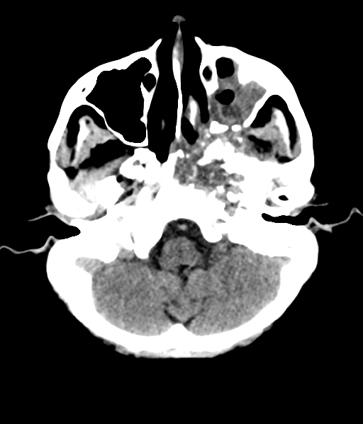 File:Nasopharyngeal carcinoma with cerebral abscess (Radiopaedia 43018-46275 Axial non-contrast 12).png
