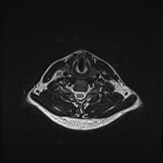 Nasopharyngeal carcinoma with perineural spread (Radiopaedia 55030-61380 Axial T2 67).jpg