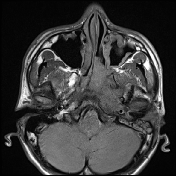 Nasopharyngeal carcinoma with skull base invasion (Radiopaedia 53415-59485 Axial T1 24).jpg