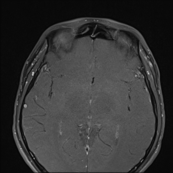 Nasopharyngeal carcinoma with skull base invasion (Radiopaedia 53415-59485 Axial T1 C+ fat sat 10).jpg
