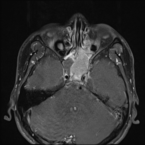 Nasopharyngeal carcinoma with skull base invasion (Radiopaedia 53415-59485 Axial T1 C+ fat sat 19).jpg