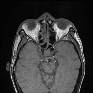 Nasopharyngeal carcinoma with skull base invasion (Radiopaedia 59258-66600 B 8).jpg