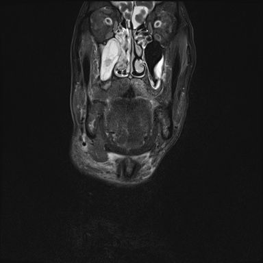 Nasopharyngeal carcinoma with skull base invasion (Radiopaedia 59258-66600 Coronal T2 fat sat 29).jpg