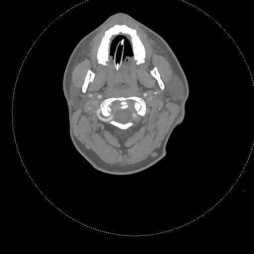 Neck CT angiogram (intraosseous vascular access) (Radiopaedia 55481-61945 B 235).jpg