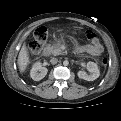 File:Necrotizing pancreatitis - acute necrotic collection maturing into walled-off pancreatic necrosis (Radiopaedia 9602-10249 A 7).jpg