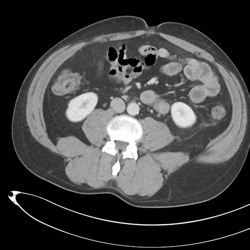 File:Necrotizing pancreatitis with acute necrotic collections (Radiopaedia 38829-41012 B 46).png