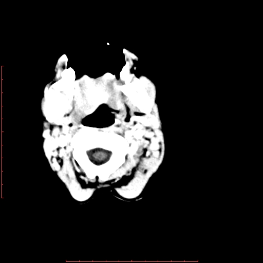 File:Neuroblastoma skull metastasis (Radiopaedia 56053-62683 Axial +Contrast 1).jpg
