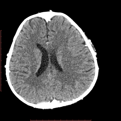 File:Neuroblastoma skull metastasis (Radiopaedia 56053-62683 Axial +Contrast 11).jpg