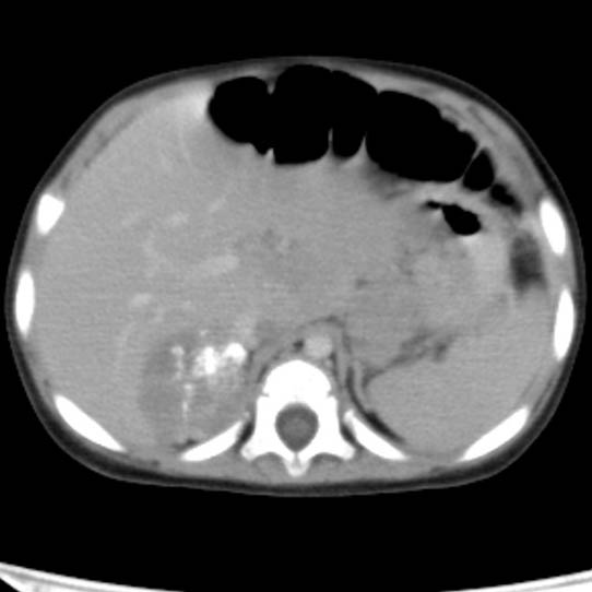 Neuroblastoma with skull metastases (Radiopaedia 30326-30960 C 13).jpg