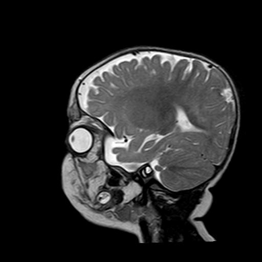 File:Neurofibromatosis type 1 (Radiopaedia 30089-30671 Sagittal T2 14).jpg