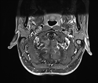 File:Neurofibromatosis type 1 (Radiopaedia 80355-93740 Axial T1 C+ fat sat 2).jpg