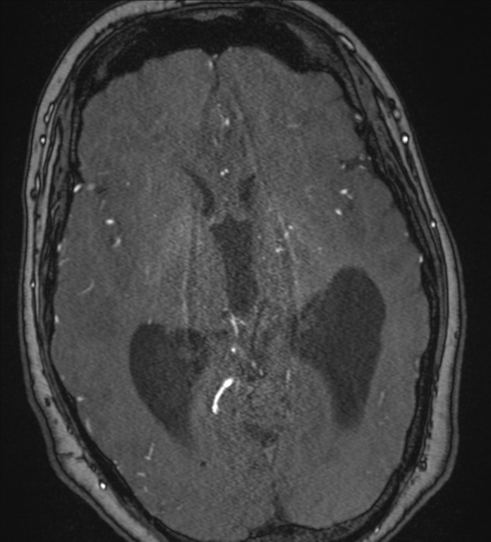 Neurofibromatosis type 1 - head and neck - CNS manifestations (Radiopaedia 49910-55188 Axial MRA 43).png