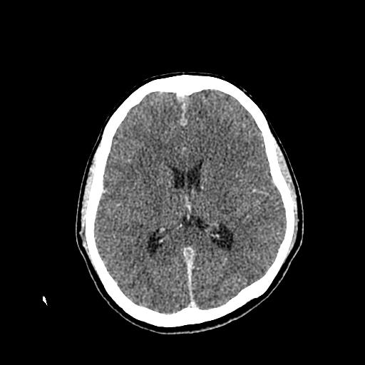 File:Neurofibromatosis type 2 (Radiopaedia 25389-25637 Axial C+ 54).jpg
