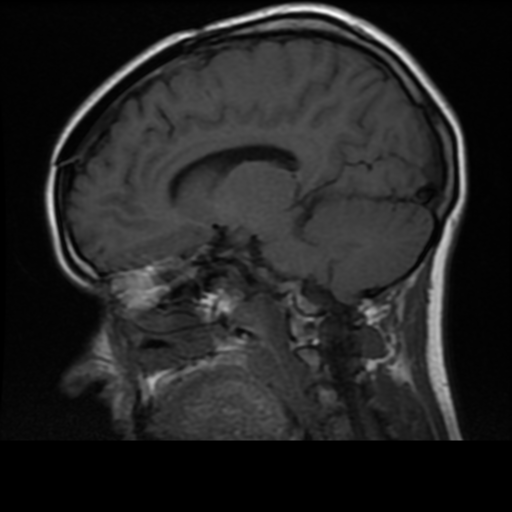File:Neurofibromatosis type 2 (Radiopaedia 45229-49244 Sagittal T1 12).png