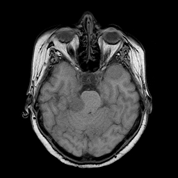 File:Neurofibromatosis type 2 (Radiopaedia 8713-9518 Axial T1 17).jpg