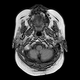 File:Neurofibromatosis type 2 (Radiopaedia 8713-9518 Axial T1 23).jpg