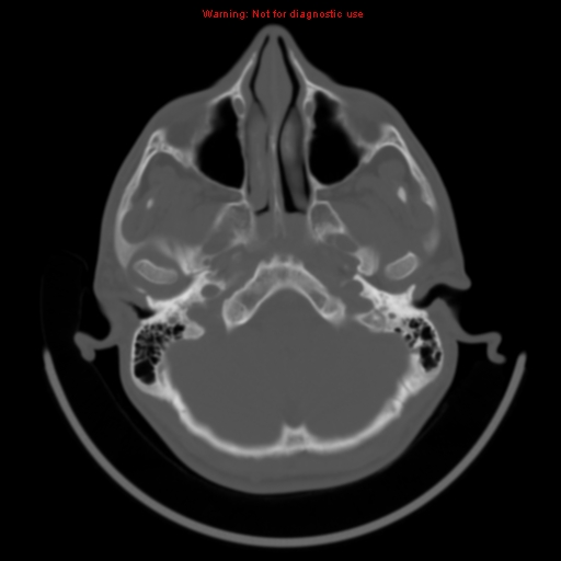 File:Neurofibromatosis type 2 (Radiopaedia 8953-9732 Axial bone window 4).jpg