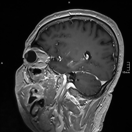 Neurosarcoidosis - involvement of the mesial temporal lobes (Radiopaedia 67429-76820 Sagittal T1 C+ 115).jpg