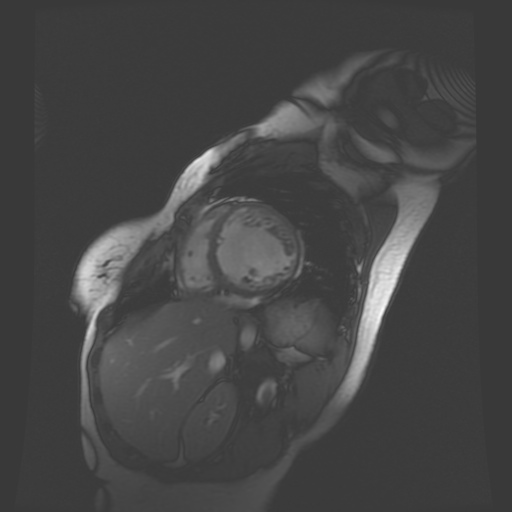 File:Non-compaction of the left ventricle (Radiopaedia 38868-41062 SAXs SSFP CINE 16).jpg