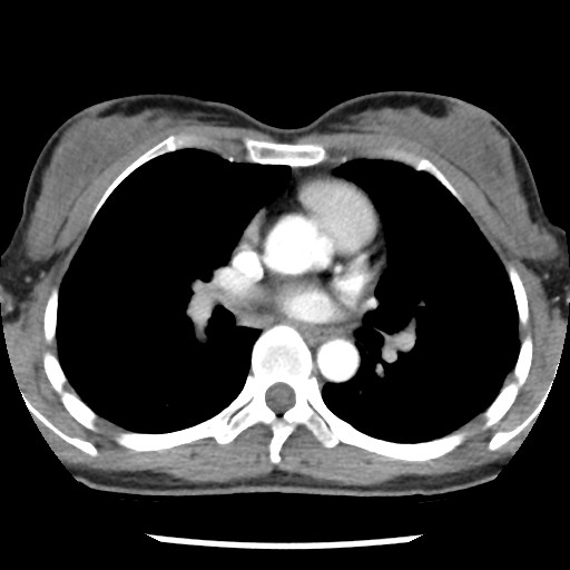 File:Non-small cell lung cancer with miliary metastases (Radiopaedia 23995-24193 A 21).jpg