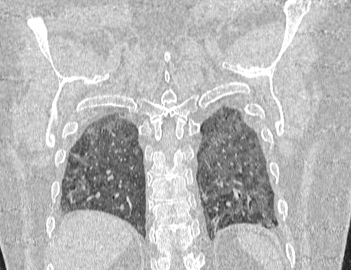 Non specific interstitial pneumonia (NSIP) (Radiopaedia 89725-106798 Coronal lung window 62).jpg