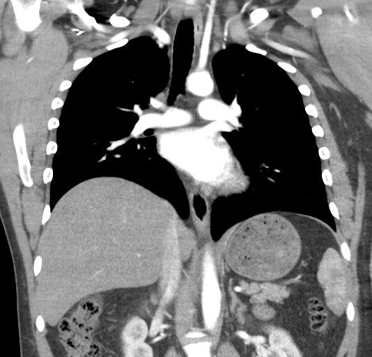 File:Normal CTA thorax (non ECG gated) (Radiopaedia 41750-44704 B 49).png