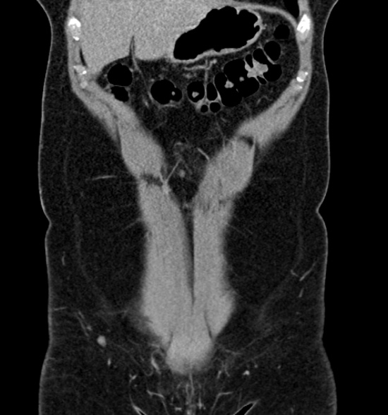 Normal CT intravenous urogram (Radiopaedia 39444-41759 A 188).jpg