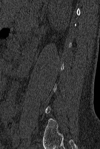 File:Normal CT lumbar spine (Radiopaedia 53981-60118 Sagittal bone window 79).jpg