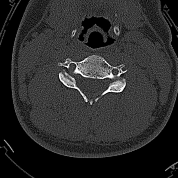 Normal CT of the cervical spine (Radiopaedia 53322-59305 Axial bone window 136).jpg