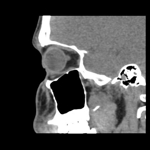 Normal CT paranasal sinuses (Radiopaedia 42286-45390 F 50).jpg