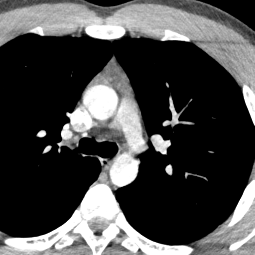 File:Normal CT pulmonary veins (pre RF ablation) (Radiopaedia 41748-44702 A 41).png