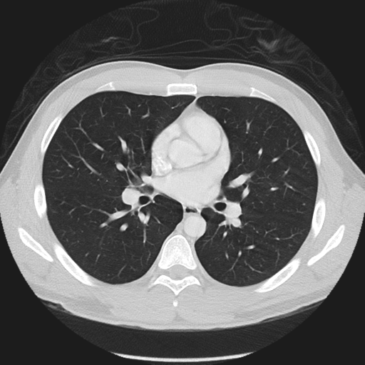 Normal CT pulmonary veins (pre RF ablation) (Radiopaedia 41748-44702 Axial lung window 21).png