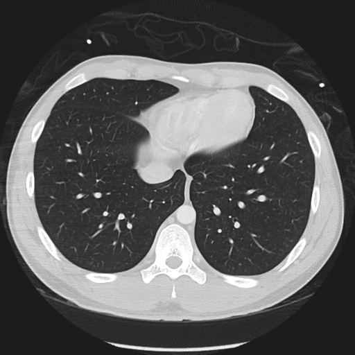 Normal CT pulmonary veins (pre RF ablation) (Radiopaedia 41748-44702 Axial lung window 46).png