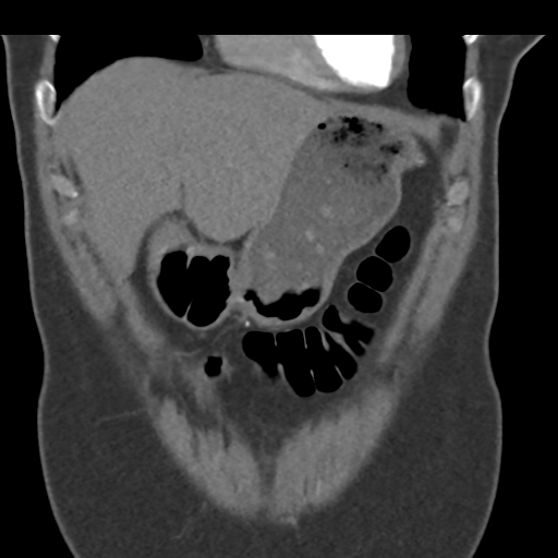 File:Normal CT renal artery angiogram (Radiopaedia 38727-40889 B 17).png