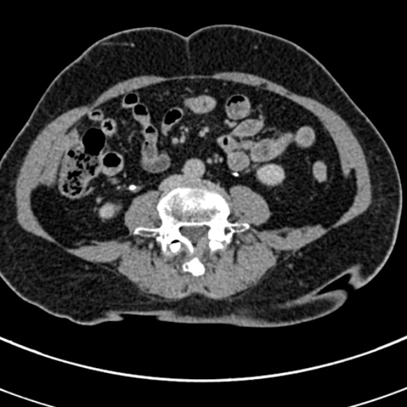 File:Normal CT split bolus study of the renal tract (Radiopaedia 48631-53634 Axial split bolus 157).jpg