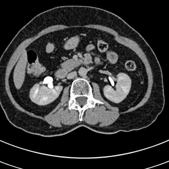File:Normal CT split bolus study of the renal tract (Radiopaedia 48631-53634 Axial split bolus 84).jpg