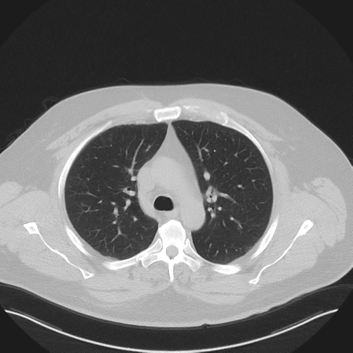 Normal HRCT (Radiopaedia 40797-43458 Axial lung window 20).png