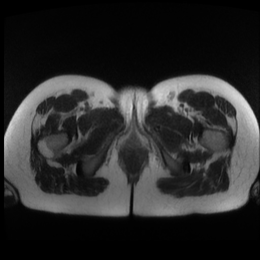 Normal MRI abdomen in pregnancy (Radiopaedia 88003-104546 Axial T2 54).jpg