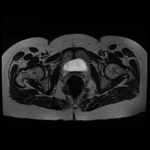 Normal MRI abdomen in pregnancy (Radiopaedia 88005-104548 Axial T2 43).jpg