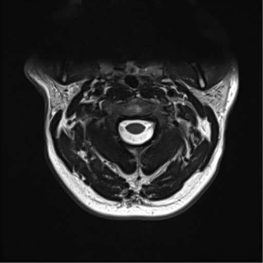 File:Normal MRI cervical spine (infection protocol) (Radiopaedia 53916-60039 Axial T2 14).png