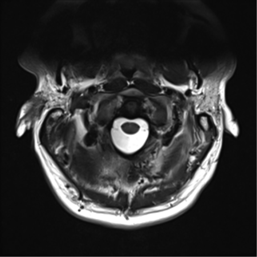 File:Normal MRI cervical spine (infection protocol) (Radiopaedia 53916-60039 Axial T2 8).png