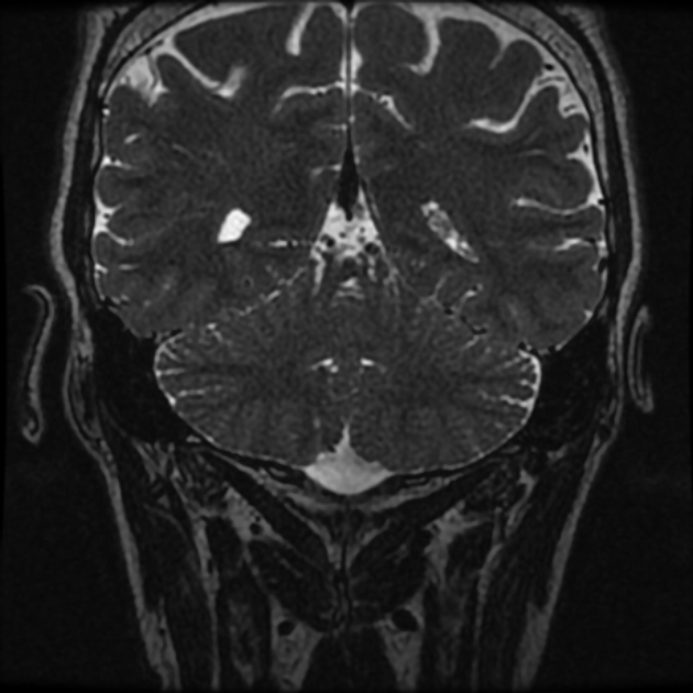 Normal MRI petrous (Radiopaedia 91317-108949 Coronal T2 103).jpg