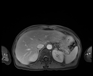 Normal adrenal glands MRI (Radiopaedia 82017-96004 M 22).jpg