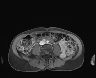 Normal adrenal glands MRI (Radiopaedia 82017-96004 M 67).jpg