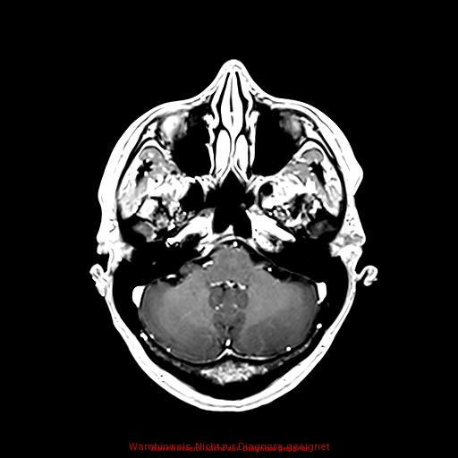 Normal adult brain MRI (non-enhanced and contrast-enhanced) (Radiopaedia 75262-86379 Axial T1 C+ 65).jpg