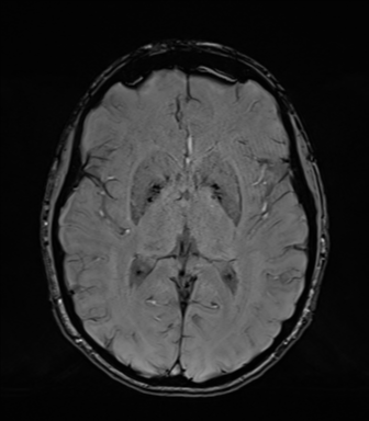 Normal brain MRI (TLE protocol) (Radiopaedia 40748-43405 Axial SWI 45).png