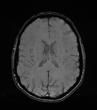Normal brain MRI (TLE protocol) (Radiopaedia 40748-43405 Axial SWI 53).png