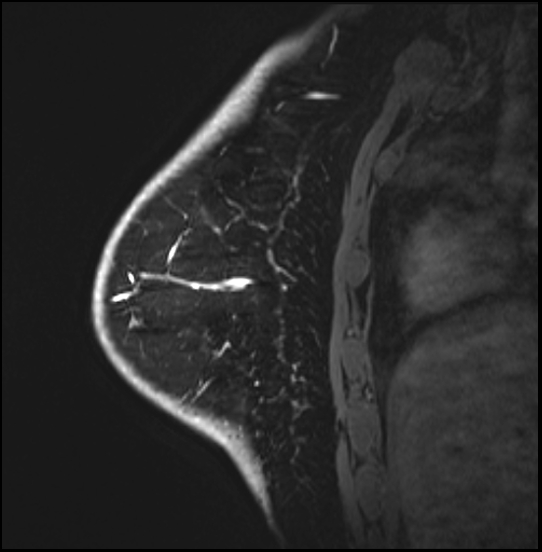 Normal breast MRI - dense breasts (Radiopaedia 80454-93850 I 143).jpg