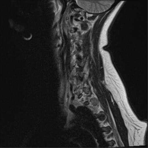 File:Normal cervical spine MRI (including Dixon) (Radiopaedia 42762-45925 Dixon- in-phase 1).png